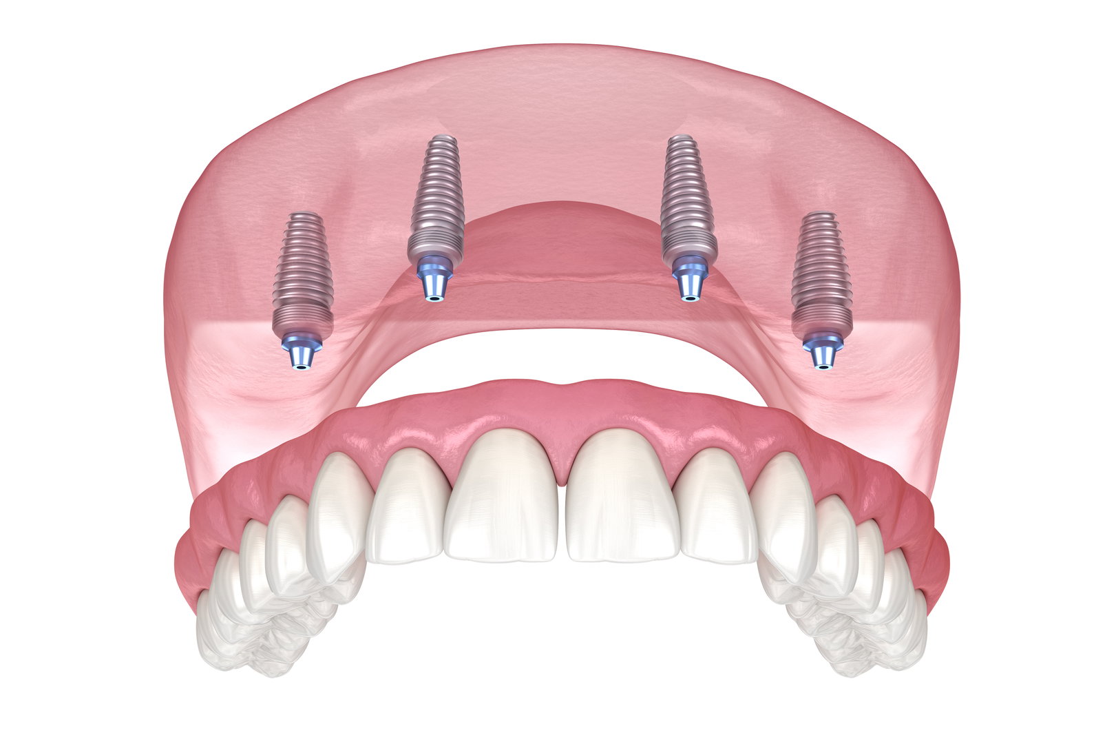 implant4