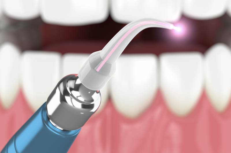 Laser Dentistry in Leesburg