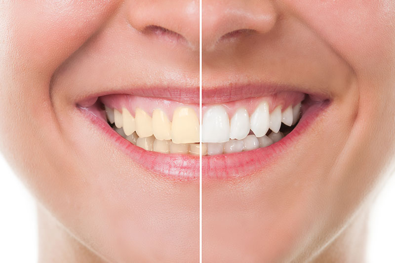 Teeth Whitening in Leesburg